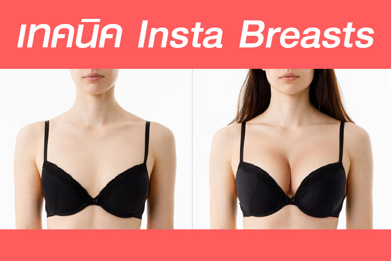 เสริมหน้าอก Insta Breasts