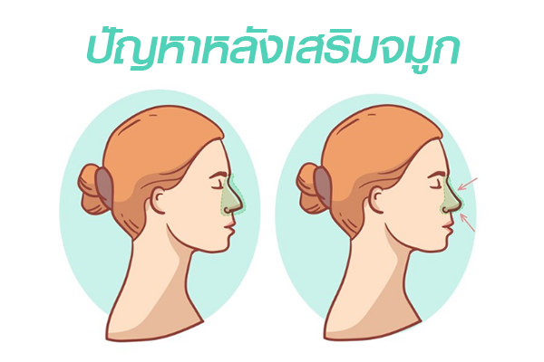 จมูกเบี้ยว-จมูกทะลุ